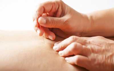 Acupuncture now at MOVE New Farm Clinic