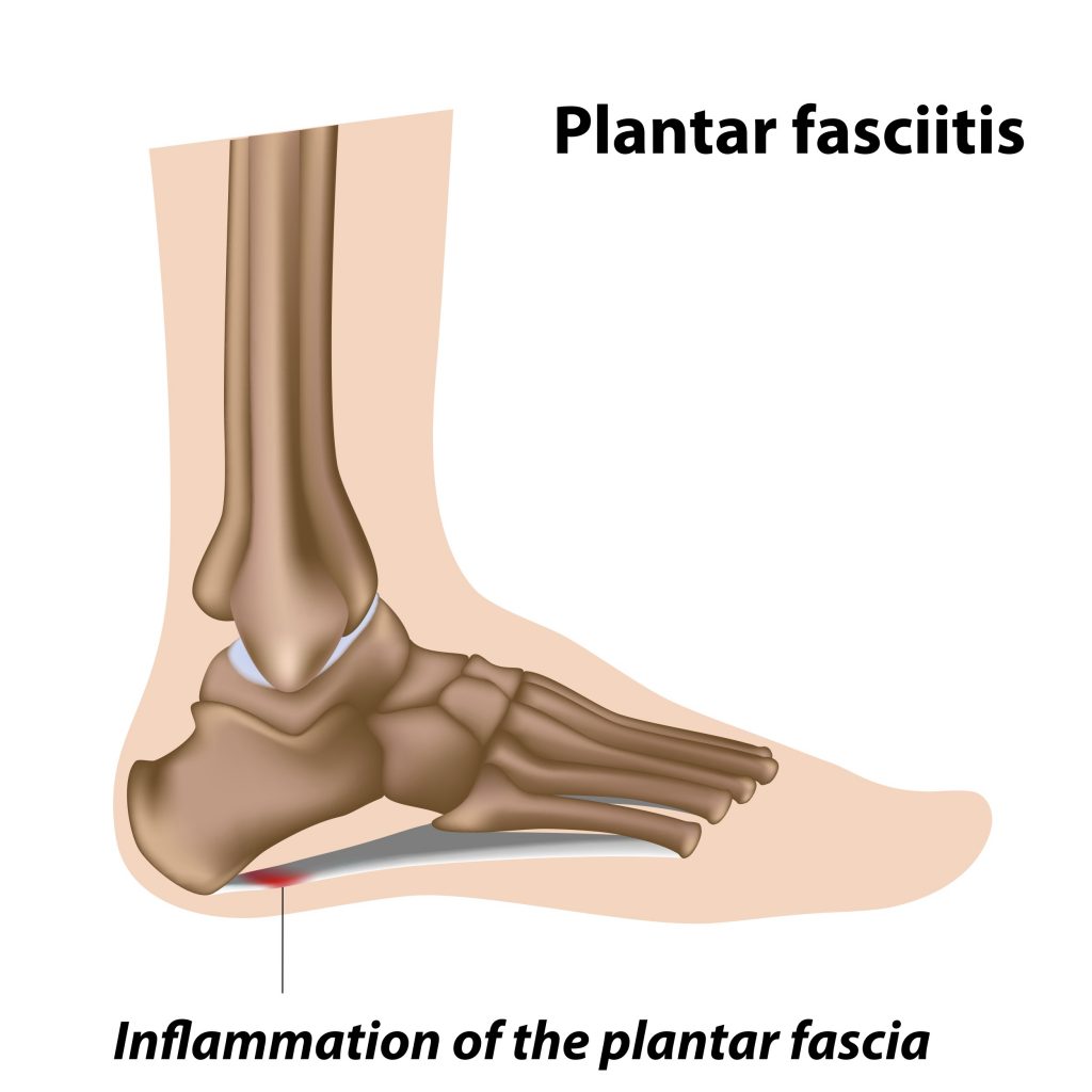 Plantar fasciitis - Move Osteopathy