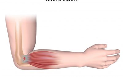 Elbow Pain – Tennis Elbow Vs Golfer’s Elbow